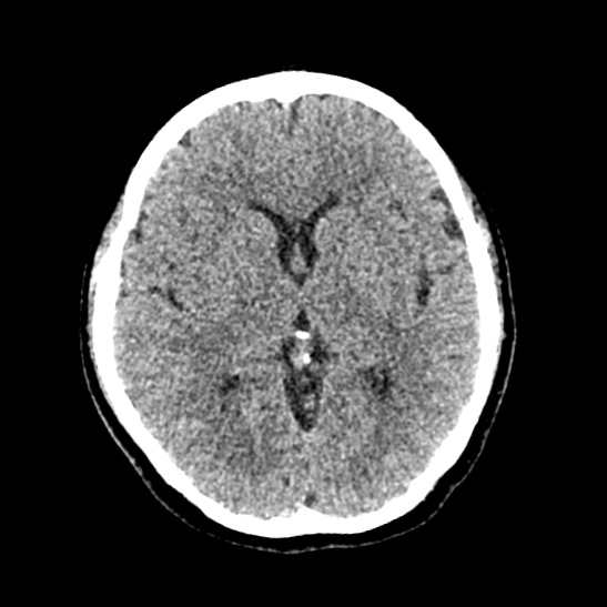 Cerebellopontine angle meningioma (Radiopaedia 53561-59592 Axial non-contrast 34).jpg