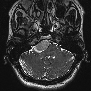 Cerebellopontine angle meningioma (Radiopaedia 72983-83680 Axial FIESTA 15).jpg