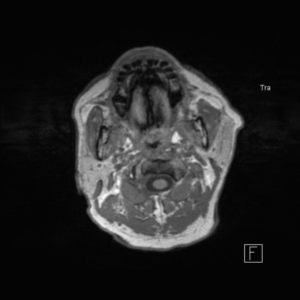 Cerebral abscess (Radiopaedia 26111-26247 Axial T1 7).jpg