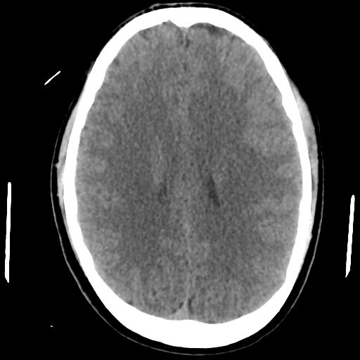File:Cerebral abscess (Radiopaedia 29451-29919 Axial non-contrast 31).jpg