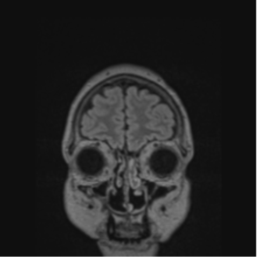 Cerebral abscess from pulmonary arteriovenous malformation (Radiopaedia 86275-102291 Coronal FLAIR 78).png
