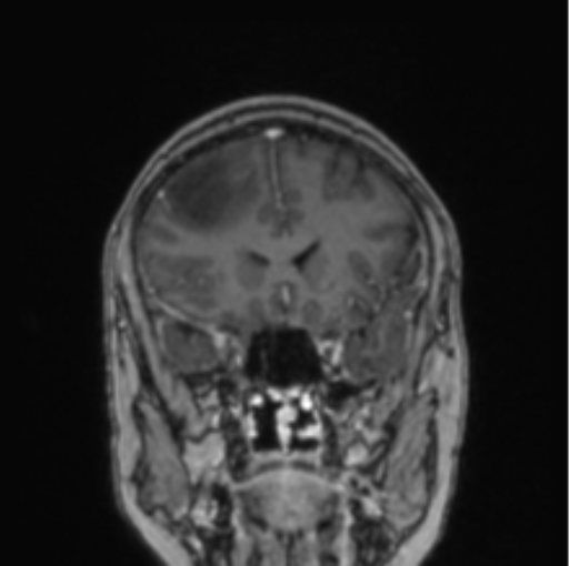 Cerebral abscess from pulmonary arteriovenous malformation (Radiopaedia 86275-102291 L 62).png