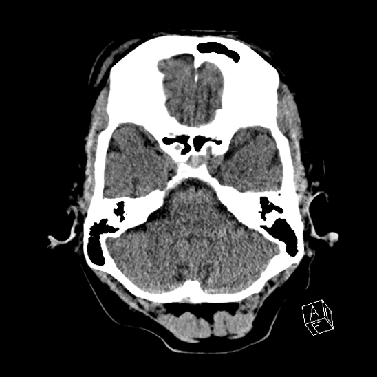 File:Cerebral abscess with ventriculitis (Radiopaedia 78965-91876 Axial non-contrast 14).jpg