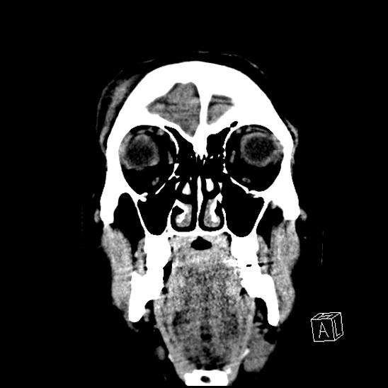 File:Cerebral abscess with ventriculitis (Radiopaedia 78965-91876 B 8).jpg
