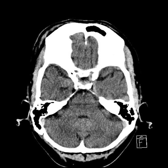 File:Cerebral abscess with ventriculitis (Radiopaedia 78965-91877 A 14).jpg