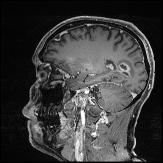 Cerebral abscess with ventriculitis (Radiopaedia 78965-91878 Sagittal T1 C+ 66).jpg