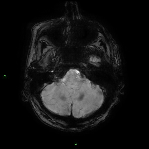 File:Cerebral amyloid angiopathy-associated lobar intracerebral hemorrhage (Radiopaedia 58376-65512 Axial SWI 11).jpg