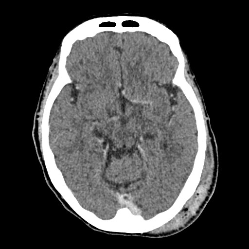 Cerebral amyloid angiopathy-related inflammation (Radiopaedia 74836-85848 Axial non-contrast 27).jpg