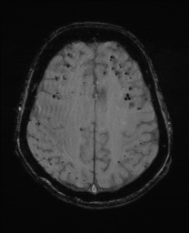 Cerebral amyloid angiopathy-related inflammation (Radiopaedia 74836-85849 Axial SWI 51).jpg