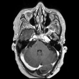 Cerebral amyloid angiopathy (Radiopaedia 29129-29518 Axial T1 C+ 42).jpg