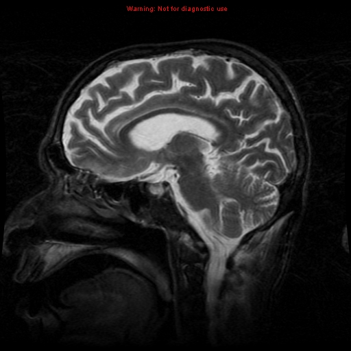 File:Cerebral and orbital tuberculomas (Radiopaedia 13308-13311 Sagittal T2 11).jpg