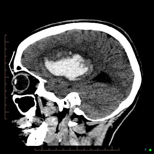 Cerebral arteriovenous malformation (AVM) (Radiopaedia 78162-90706 A 25).jpg
