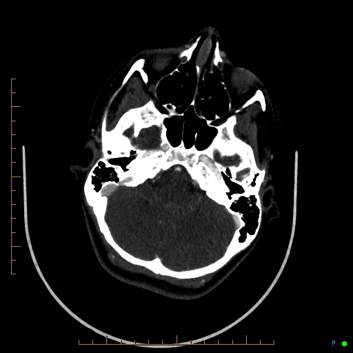 Cerebral arteriovenous malformation (AVM) (Radiopaedia 78162-90706 Axial CTA 76).jpg