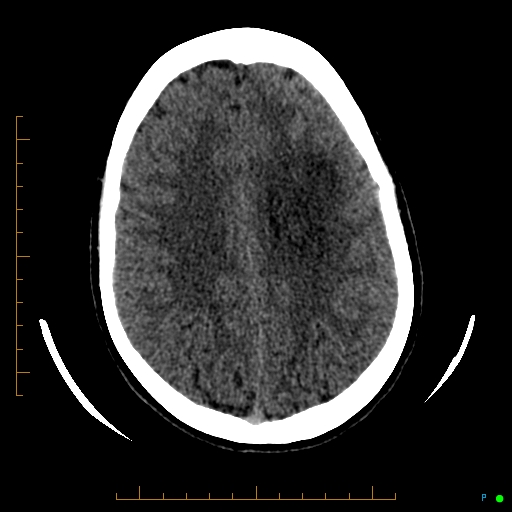 Cerebral arteriovenous malformation (AVM) (Radiopaedia 78162-90706 Axial non-contrast 45).jpg