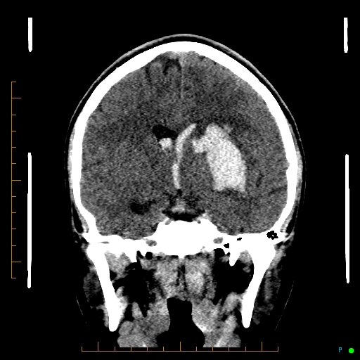 Cerebral arteriovenous malformation (AVM) (Radiopaedia 78162-90706 Coronal non-contrast 48).jpg