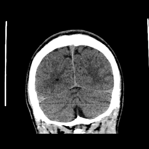 Cerebral arteriovenous malformation (Radiopaedia 61964-70028 Coronal non-contrast 51).jpg