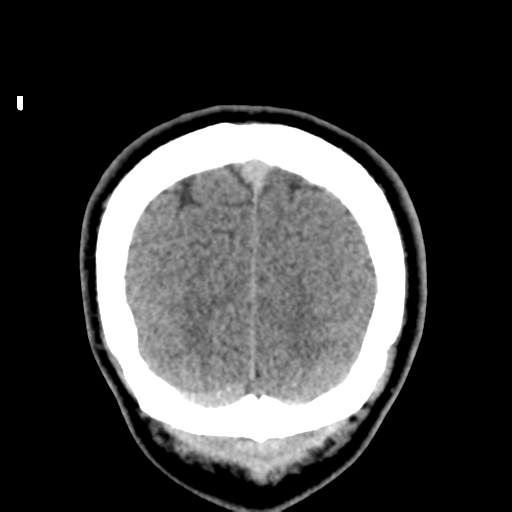 Cerebral arteriovenous malformation (Spetzler-Martin grade 2) (Radiopaedia 41262-44076 Coronal non-contrast 58).png