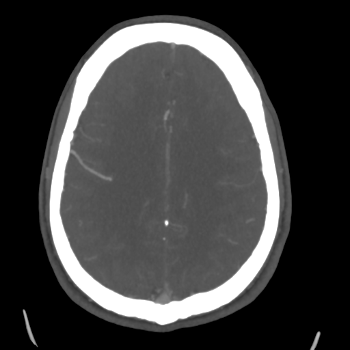 Cerebral arteriovenous malformation (Spetzler-Martin grade 2) (Radiopaedia 41262-44076 E 38).png