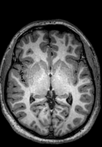 Cerebral arteriovenous malformation at posterior body of corpus callosum (Radiopaedia 74111-84925 Axial T1 153).jpg