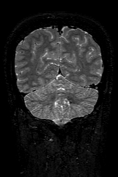 Cerebral arteriovenous malformation at posterior body of corpus callosum (Radiopaedia 74111-84925 Coronal T2 141).jpg
