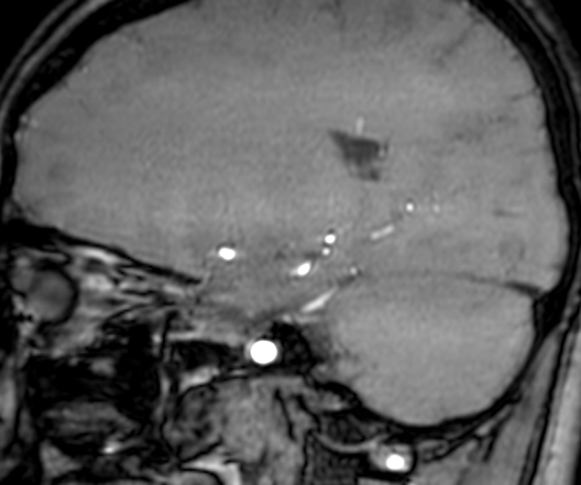 Cerebral arteriovenous malformation at posterior body of corpus callosum (Radiopaedia 74111-84925 J 136).jpg
