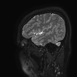 Cerebral arteriovenous malformation at posterior body of corpus callosum (Radiopaedia 74111-84925 Sagittal T2 114).jpg