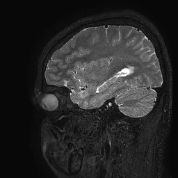 Cerebral arteriovenous malformation at posterior body of corpus callosum (Radiopaedia 74111-84925 Sagittal T2 31).jpg