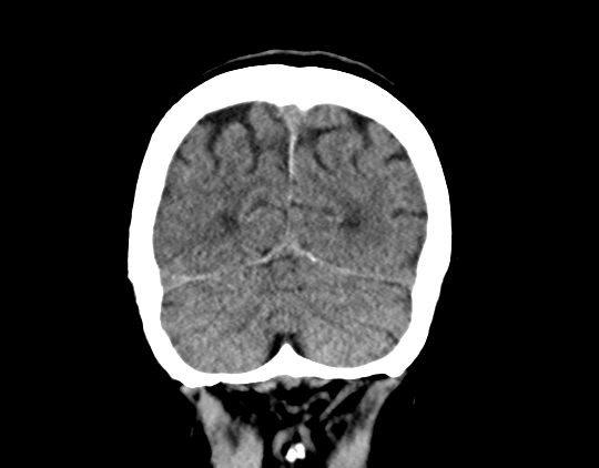 File:Cerebral arteriovenous malformation with lobar hemorrhage (Radiopaedia 44725-48510 Coronal non-contrast 40).png
