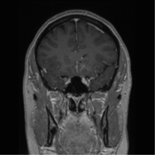 Cerebral cavernoma and development venous anomaly (Radiopaedia 37603-39482 Coronal T1 C+ 64).png