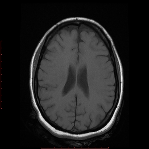 File:Cerebral cavernous malformation (Radiopaedia 26177-26306 Axial T1 14).jpg