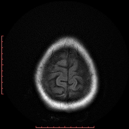 File:Cerebral cavernous malformation (Radiopaedia 26177-26306 FLAIR 20).jpg