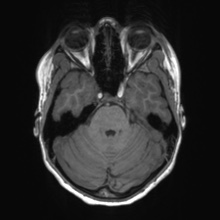 Cerebral cavernous venous malformation (Radiopaedia 70008-80021 Axial T1 20).jpg