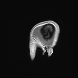 File:Cerebral cavernous venous malformation (Radiopaedia 70008-80021 Sagittal T1 C+ 71).jpg