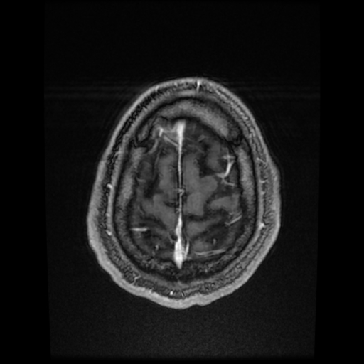 Cerebral cavernous venous malformation (Zabramski type II) (Radiopaedia 85511-101198 Axial T1 C+ fat sat 15).jpg
