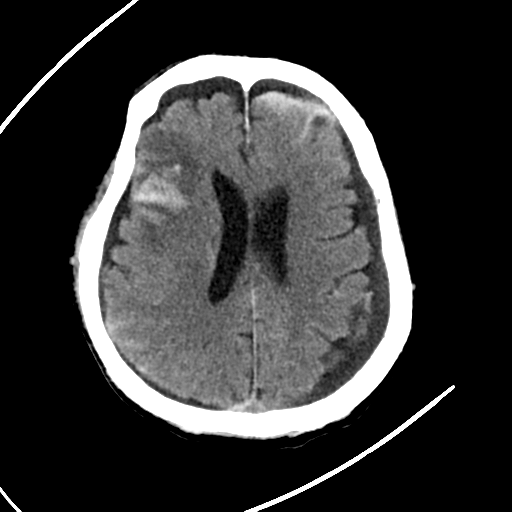 File:Cerebral contusions, subarachnoid hemorrhage and subdural hygromas (Radiopaedia 55399-61830 Axial non-contrast 20).png