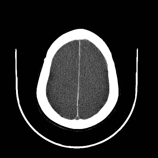 Cerebral edema (evolution in time) (Radiopaedia 19418-19439 non-contrast 74).jpg