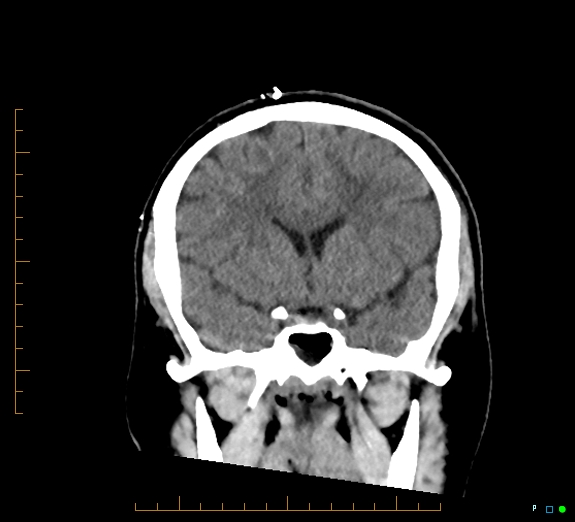 Cerebral fat embolism (Radiopaedia 85521-101220 Coronal non-contrast 26).jpg