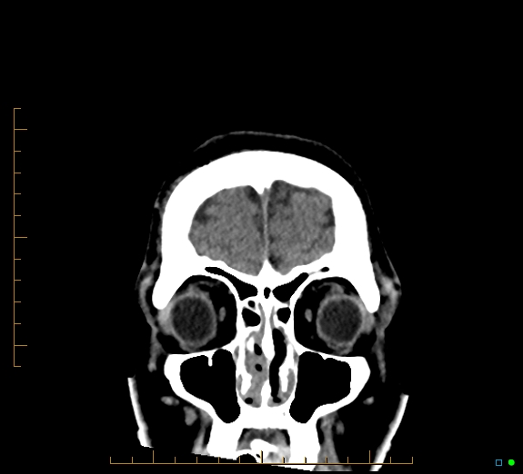 Cerebral fat embolism (Radiopaedia 85521-101224 Coronal non-contrast 10).jpg