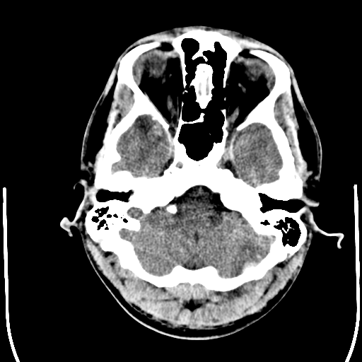 File:Cerebral hemorrhagic contusions- temporal evolution (Radiopaedia 40224-42754 Axial non-contrast 4).png