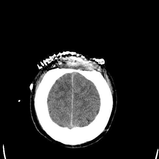 File:Cerebral hemorrhagic contusions- temporal evolution (Radiopaedia 40224-42755 AXIAL THICK 28).png