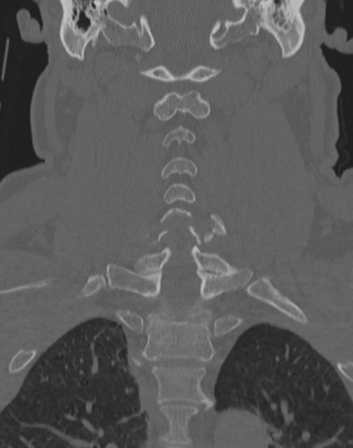 Cerebral hemorrhagic contusions and cervical spine fractures (Radiopaedia 32865-33841 Coronal bone window 42).jpg