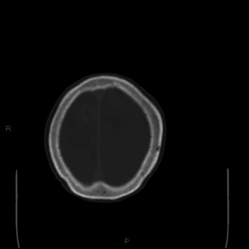 Cerebral metastases - breast primary (Radiopaedia 77653-89857 Axial bone window 101).jpg