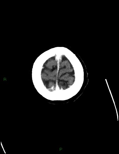 File:Cerebral metastases - ependymal and parenchymal (Radiopaedia 79877-93131 Axial C+ delayed 80).jpg