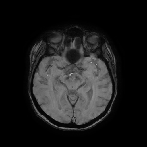 File:Cerebral metastases - melanoma (Radiopaedia 80972-94522 Axial SWI 44).jpg