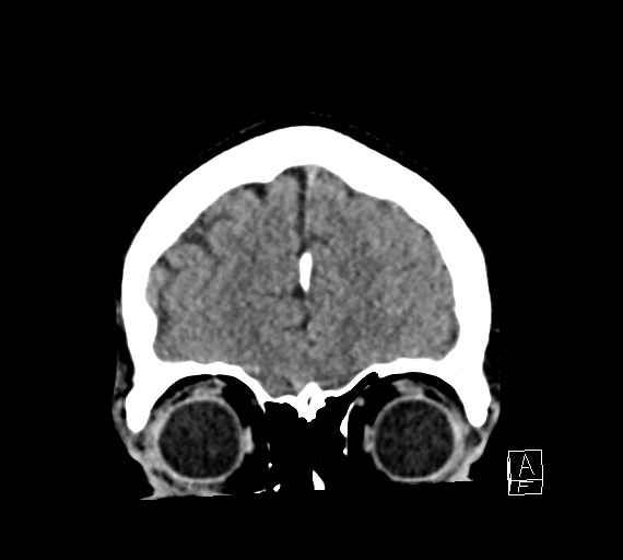 Cerebral metastases - testicular choriocarcinoma (Radiopaedia 84486-99855 Coronal C+ delayed 12).jpg
