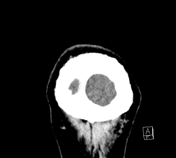 Cerebral metastases - testicular choriocarcinoma (Radiopaedia 84486-99855 D 61).jpg