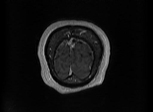 File:Cerebral metastases from lung cancer with amyloid angiopathy and cerebellopontine angle meningioma (Radiopaedia 74306-85191 Coronal T1 C+ 60).jpg