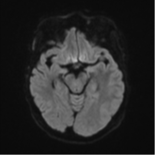 Cerebral metastasis (Radiopaedia 46744-51248 Axial DWI 39).png