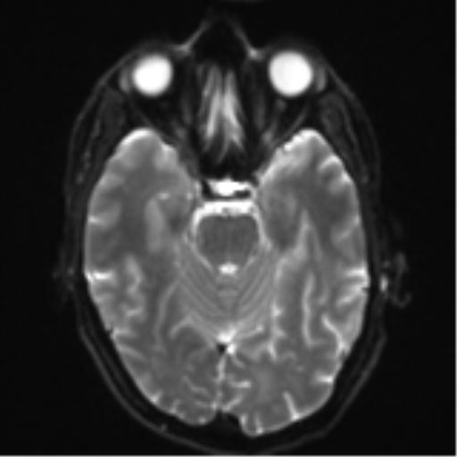 Cerebral metastasis - melanoma (Radiopaedia 54718-60954 Axial DWI 11).png
