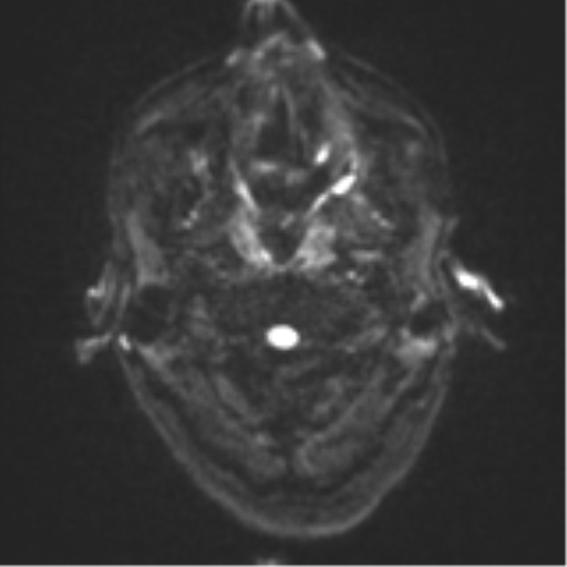 File:Cerebral metastasis - melanoma (Radiopaedia 54718-60954 Axial DWI 31).png